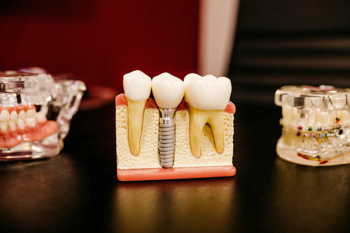 Dental Implants Image