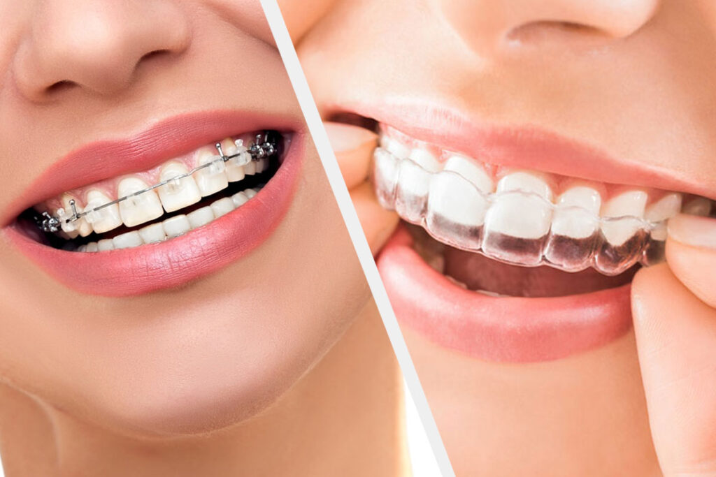 Invisalign-Vs-braces