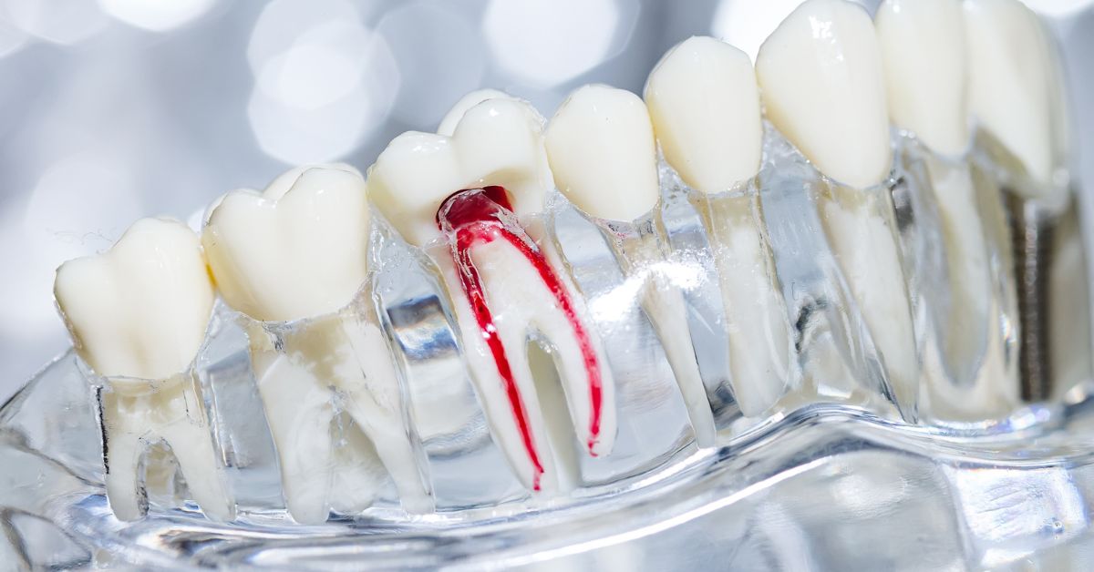 Root-Canal-Treatment-Featured-Image