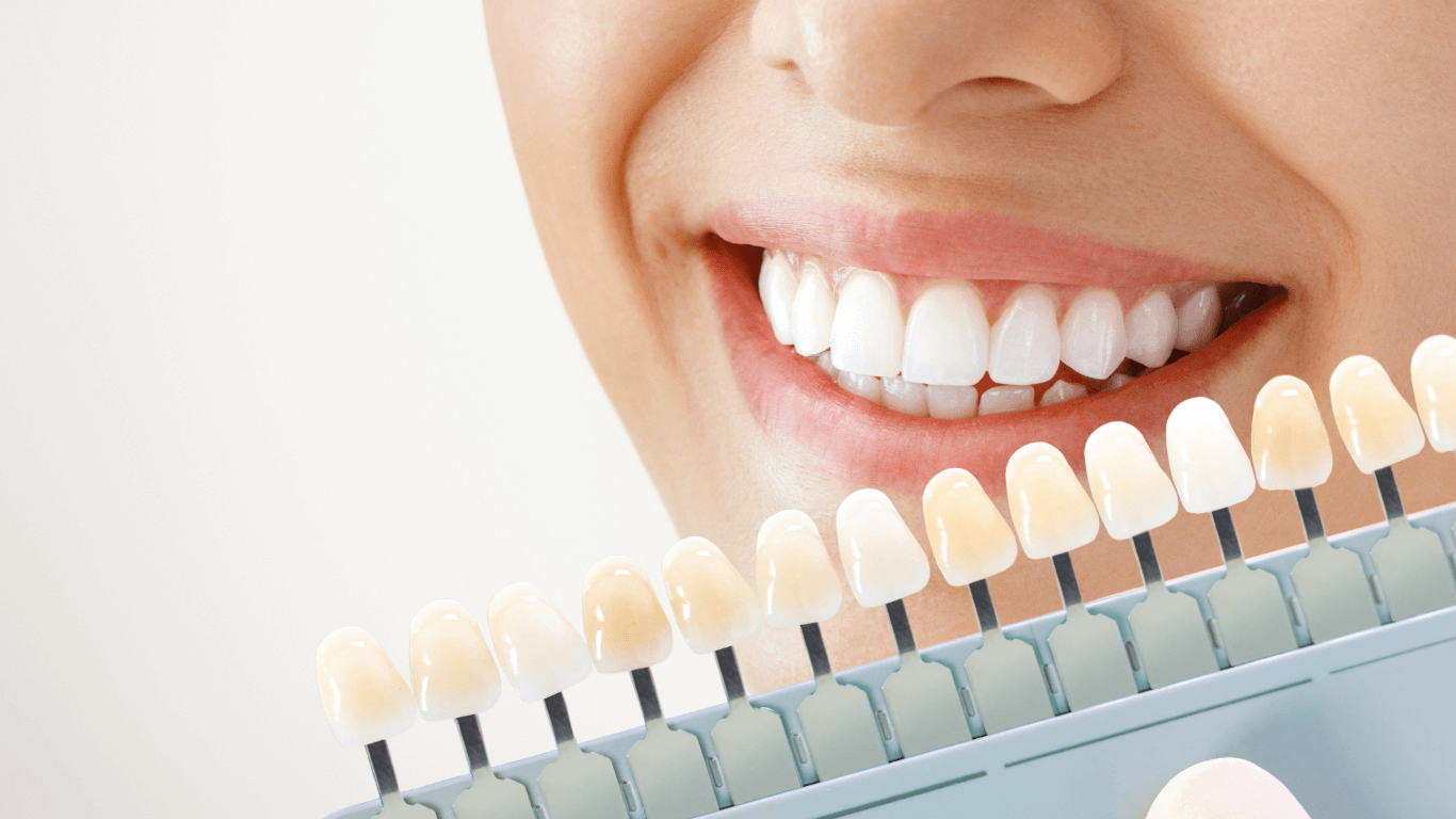 tooth whitening